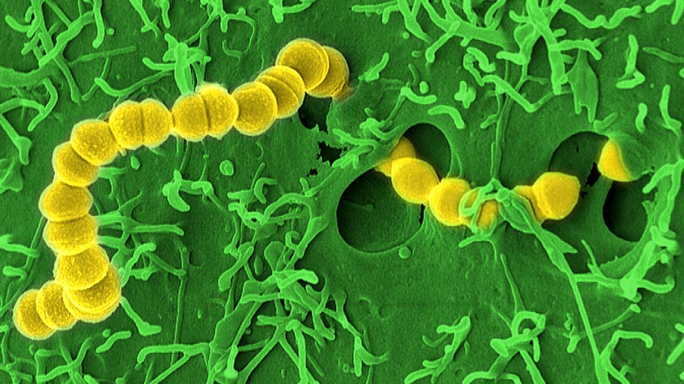 Streptococcus pyogenes ist der Hauptauslöser der nekrotisierenden Fasziitis.