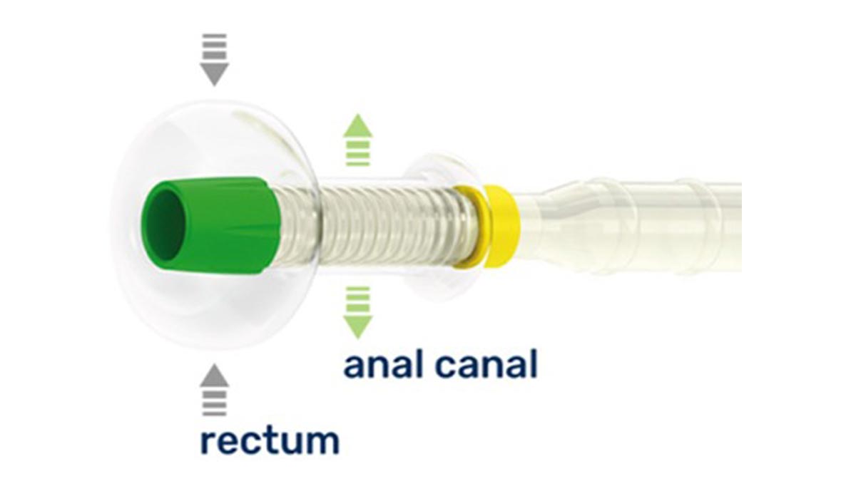 Stuhlmanagement mit Stuhldrainagesystem