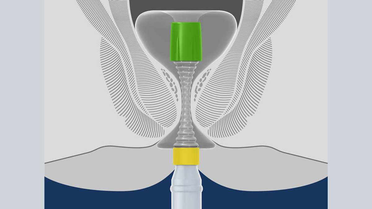 Stuhldrainage